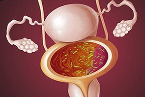 Бактериален цистит при жена